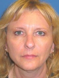Browlift Before and After | Plastic Surgery Institute of Washington