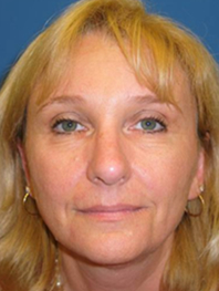 Browlift Before and After | Plastic Surgery Institute of Washington