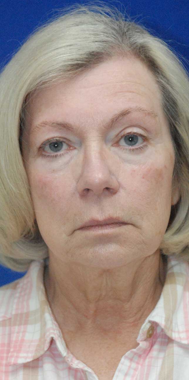 Browlift Before and After | Plastic Surgery Institute of Washington
