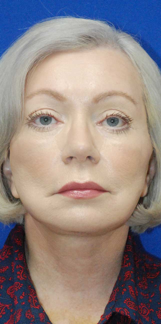 Browlift Before and After | Plastic Surgery Institute of Washington