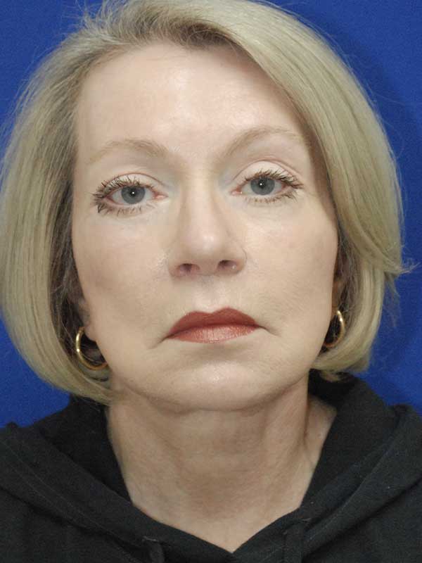 Browlift Before and After | Plastic Surgery Institute of Washington