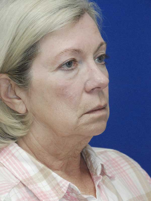 Browlift Before and After | Plastic Surgery Institute of Washington