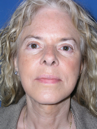 Browlift Before and After | Plastic Surgery Institute of Washington