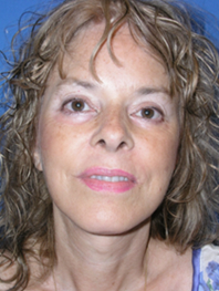 Browlift Before and After | Plastic Surgery Institute of Washington