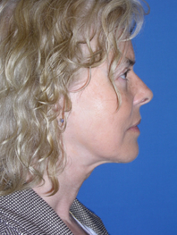 Browlift Before and After | Plastic Surgery Institute of Washington