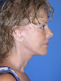 Browlift Before and After | Plastic Surgery Institute of Washington