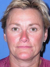Browlift Before and After | Plastic Surgery Institute of Washington