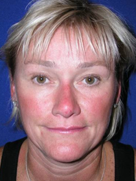 Browlift Before and After | Plastic Surgery Institute of Washington
