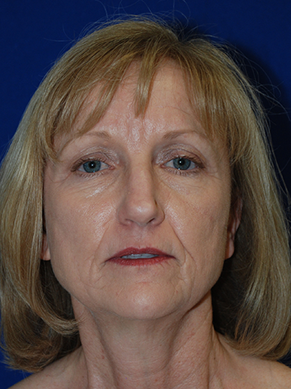 Browlift Before and After | Plastic Surgery Institute of Washington