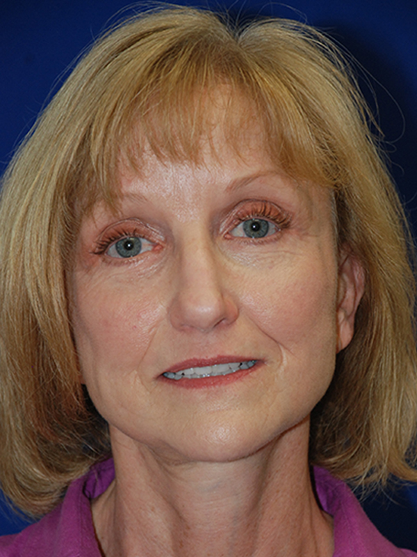 Browlift Before and After | Plastic Surgery Institute of Washington