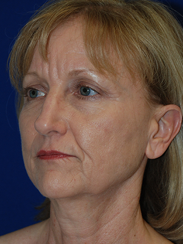 Browlift Before and After | Plastic Surgery Institute of Washington