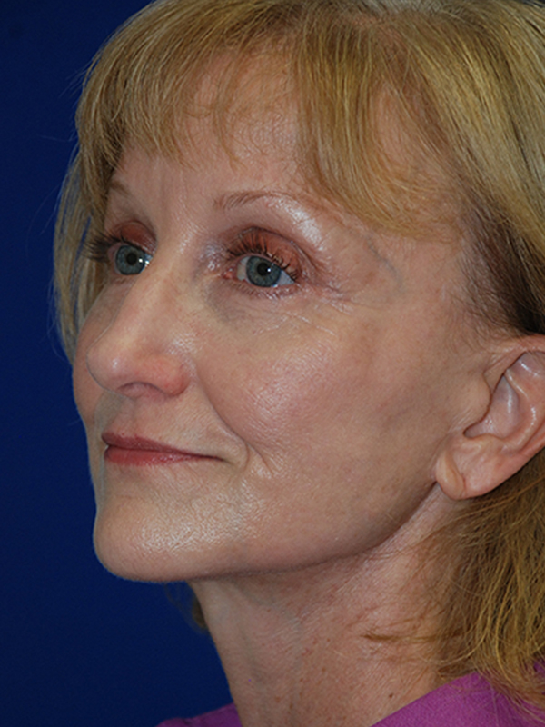 Browlift Before and After | Plastic Surgery Institute of Washington