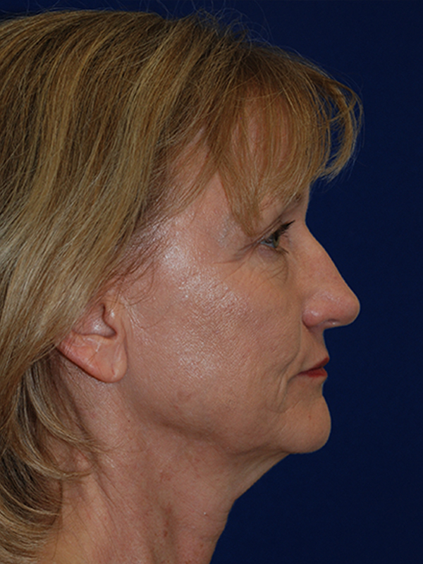 Browlift Before and After | Plastic Surgery Institute of Washington