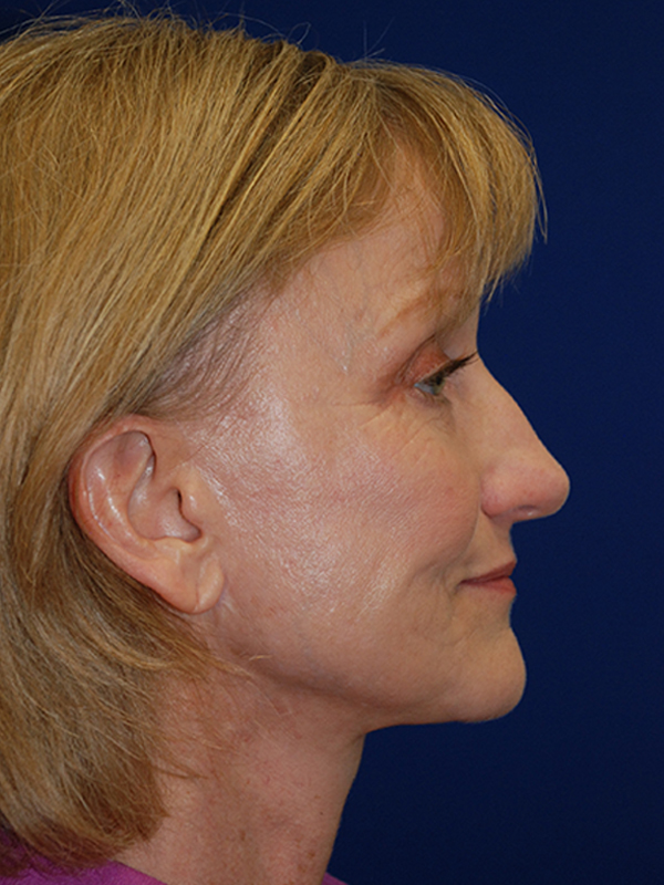 Browlift Before and After | Plastic Surgery Institute of Washington